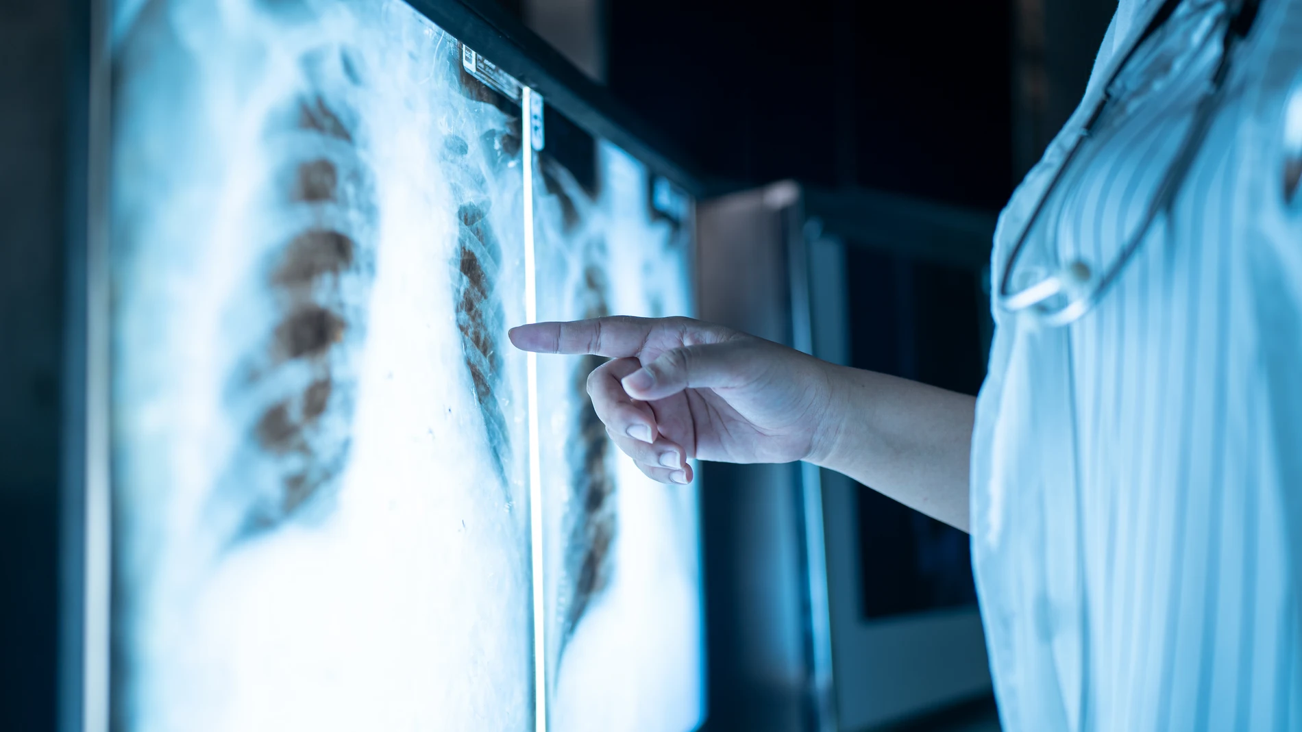Radiografía de cáncer de pulmón