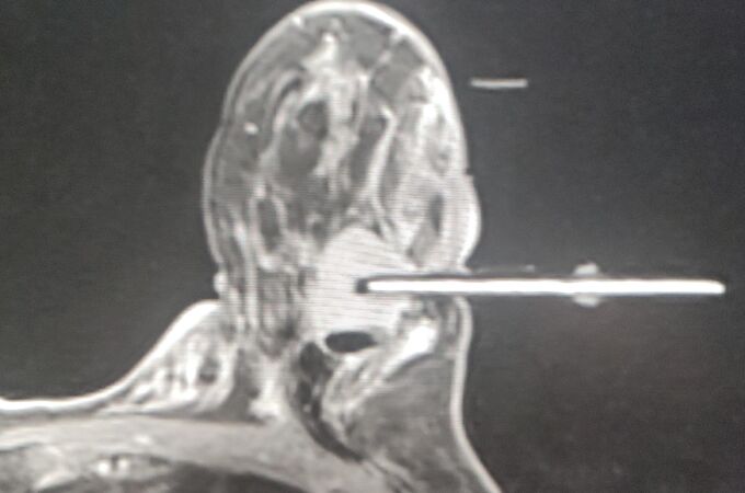 Biopsia con aguja de vacío de mama guiada con Resonancia Magnética