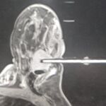 Biopsia con aguja de vacío de mama guiada con Resonancia Magnética