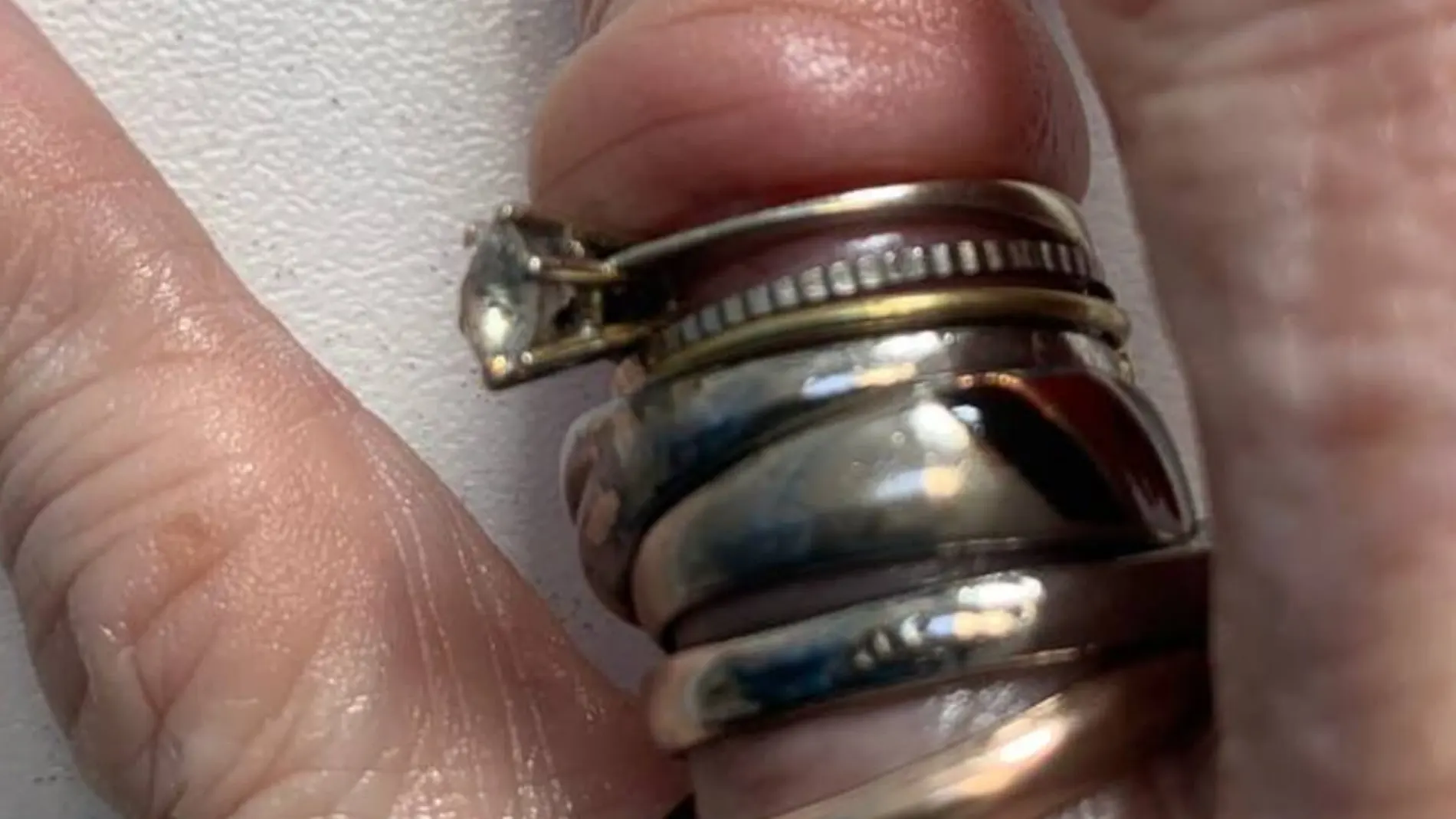 Retiran seis anillos que oprimían el dedo de una mujer