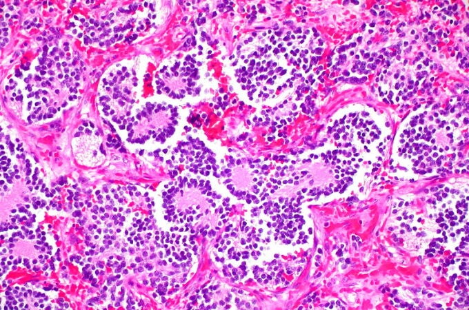 Imagen microscópica del neuroblastoma