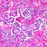 Imagen microscópica del neuroblastoma