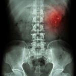 Las piedras en el riñón o cálculo renal son muy peligrosas para el funcionamiento de los órganos principales