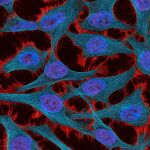 Imagen en detalle de células cancerosas en el útero