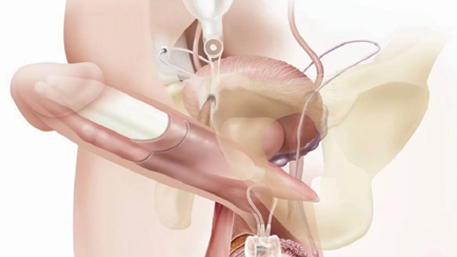Las prótesis de pene pueden solucionar hasta el 90% de los casos complejos de disfunción eréctil en pacientes oncológicos