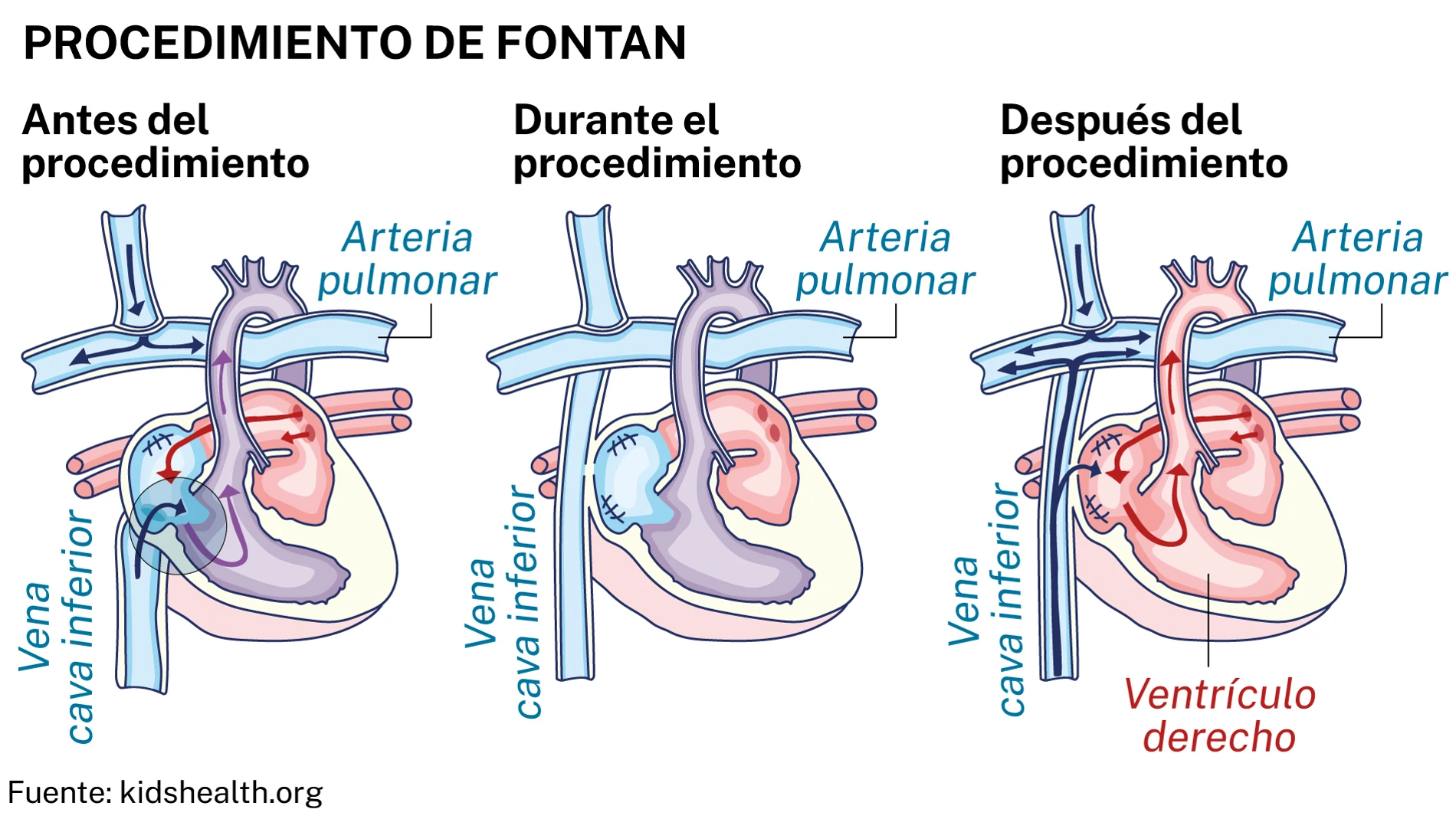 Procedimiento de Fontan