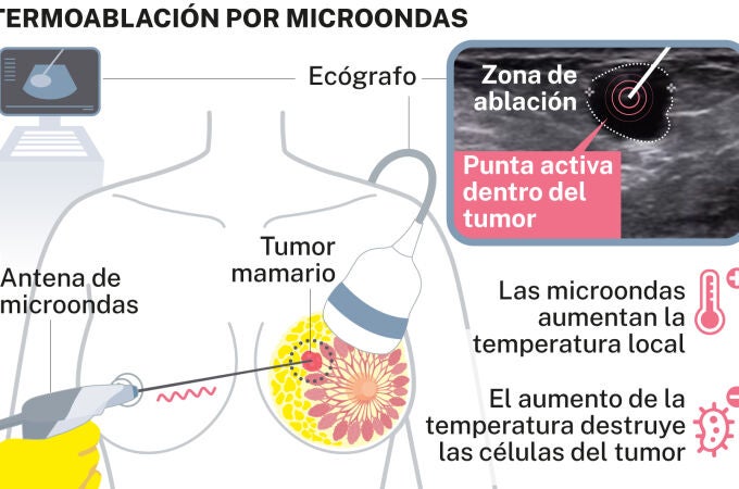 Termoablación por microondas de tumor de mama