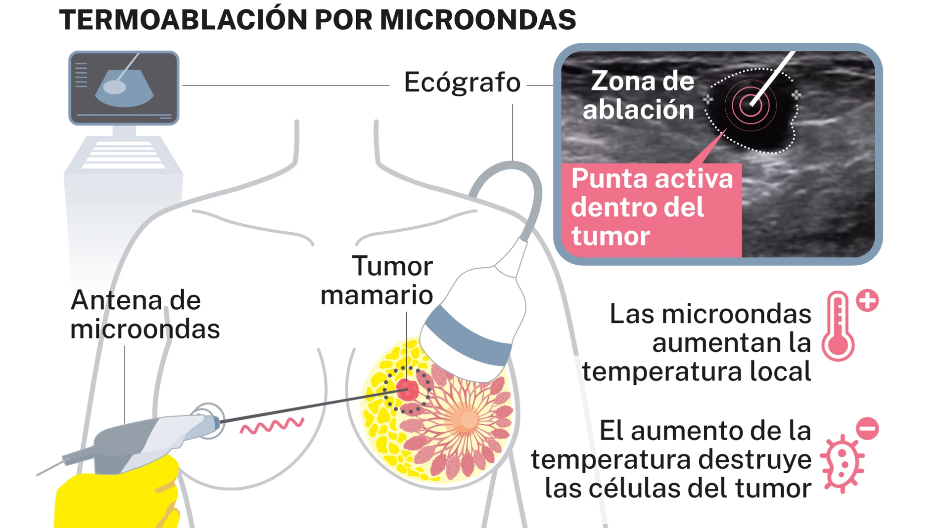 Termoablación por microondas de tumor de mama