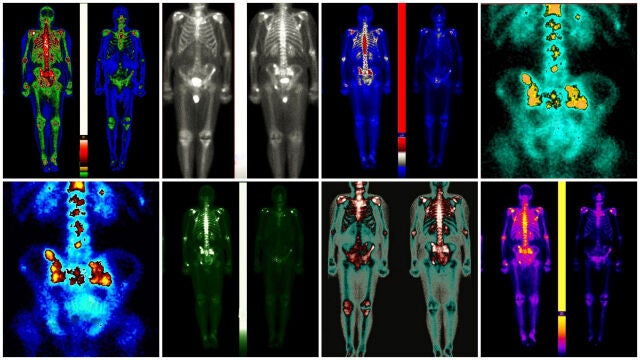 Metástasis del cáncer de próstata, una de las enfermedades que más padecen los hombres y que afecta a un gran porcentaje de la población masculina