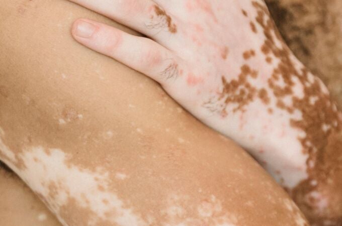 El vitíligo es una afección de la piel que se presenta en más o menos una de cada 100 personas