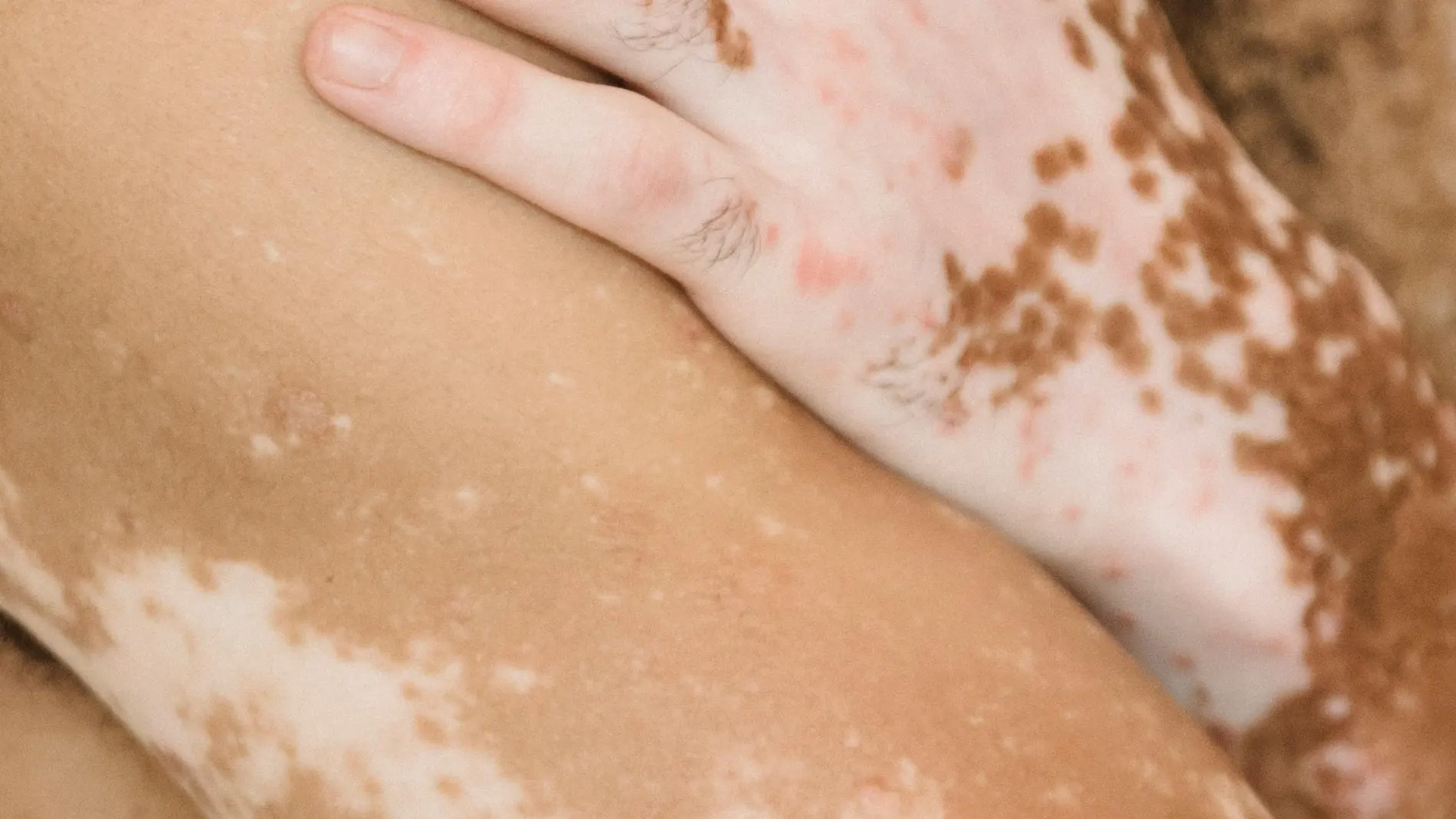 El vitíligo es una afección de la piel que se presenta en más o menos una de cada 100 personas