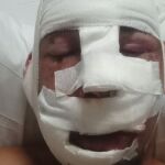 Jaime Cuesta tras una de las cirugías a causa del accidente