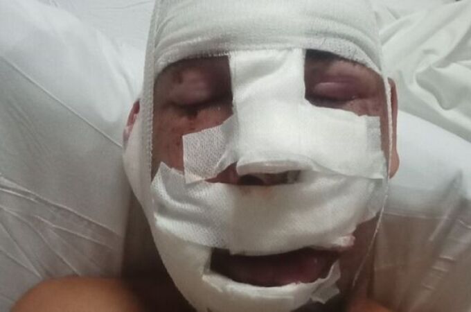 Jaime Cuesta tras una de las cirugías a causa del accidente