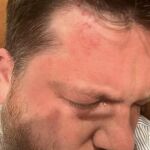  Leonid Volkov, jefe de equipo del líder opositor ruso Alexéi Navalni, tras ser golpeado en Lituania