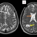 Imágenes del cerebro del paciente estadounidense 
