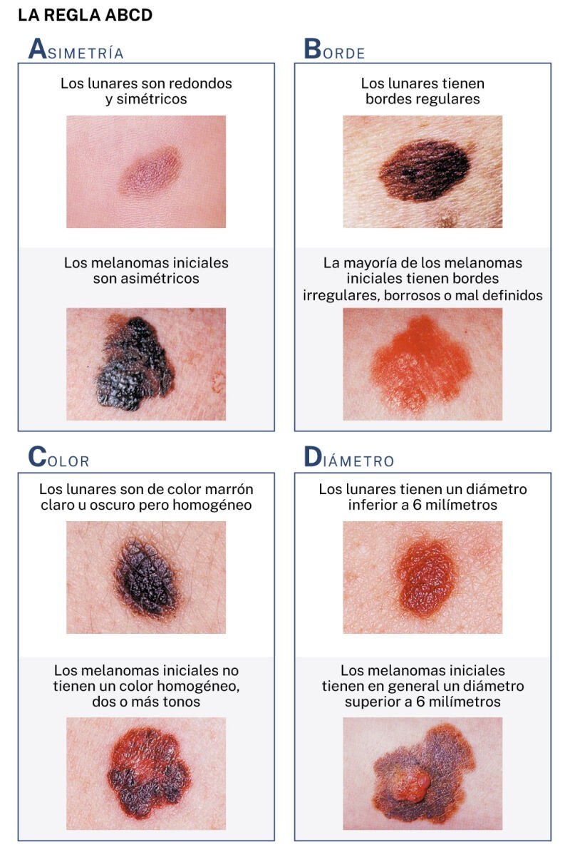 Detectar el melanoma