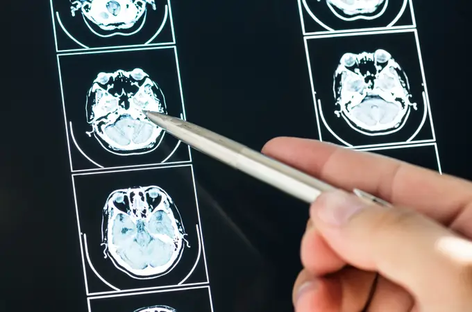 Identifican los tres factores que más aceleran el envejecimiento del cerebro, según Oxford
