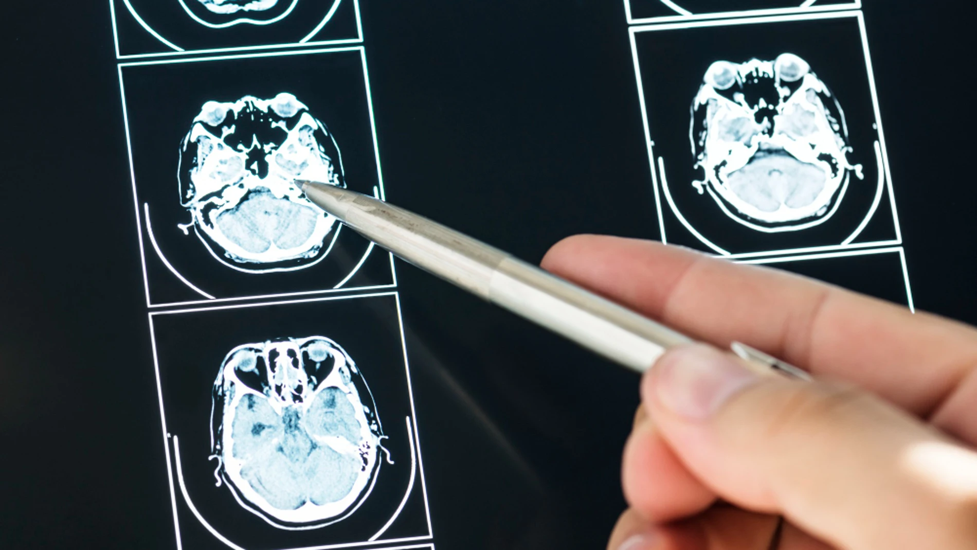 cerebro envejecimiento escaner neurologia