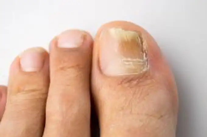 Como eliminar y prevenir los hongos de las uñas de los pies