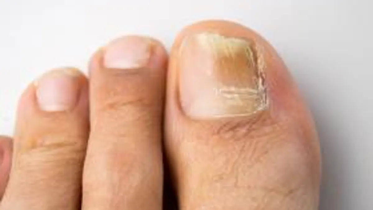 Como eliminar y prevenir los hongos de las uñas de los pies