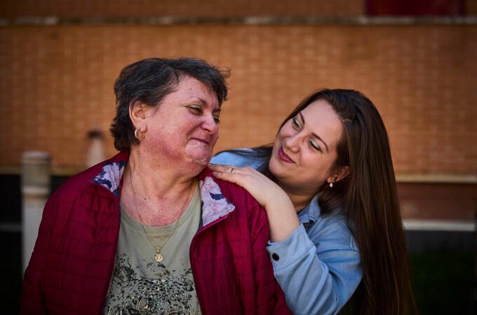 Mariana Moisa, con síndrome de Cushing, y su hija Irina