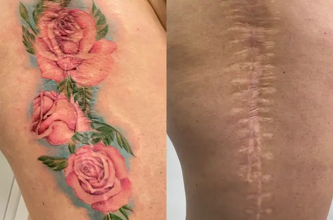 «Tatuaje de reparación» para enfermedades que dejan cicatrices