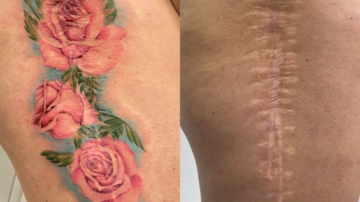 «Tatuaje de reparación» para enfermedades que dejan cicatrices