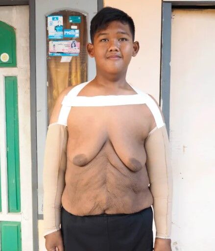 Arya Permana es un joven de 18 años que hace casi una década se hizo famoso por ser considerado el niño más gordo del mundo