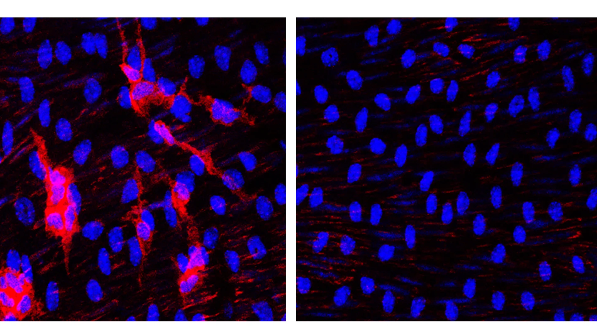 La acumulación de leucocitos (células en rojo) en la aorta de ratones progeroides (izquierda) se previene completamente al eliminar progerina en las células de músculo liso vascular (derecha)