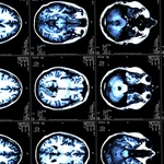 Una resonancia magnética cerebral de una paciente con esclerosis múltiple