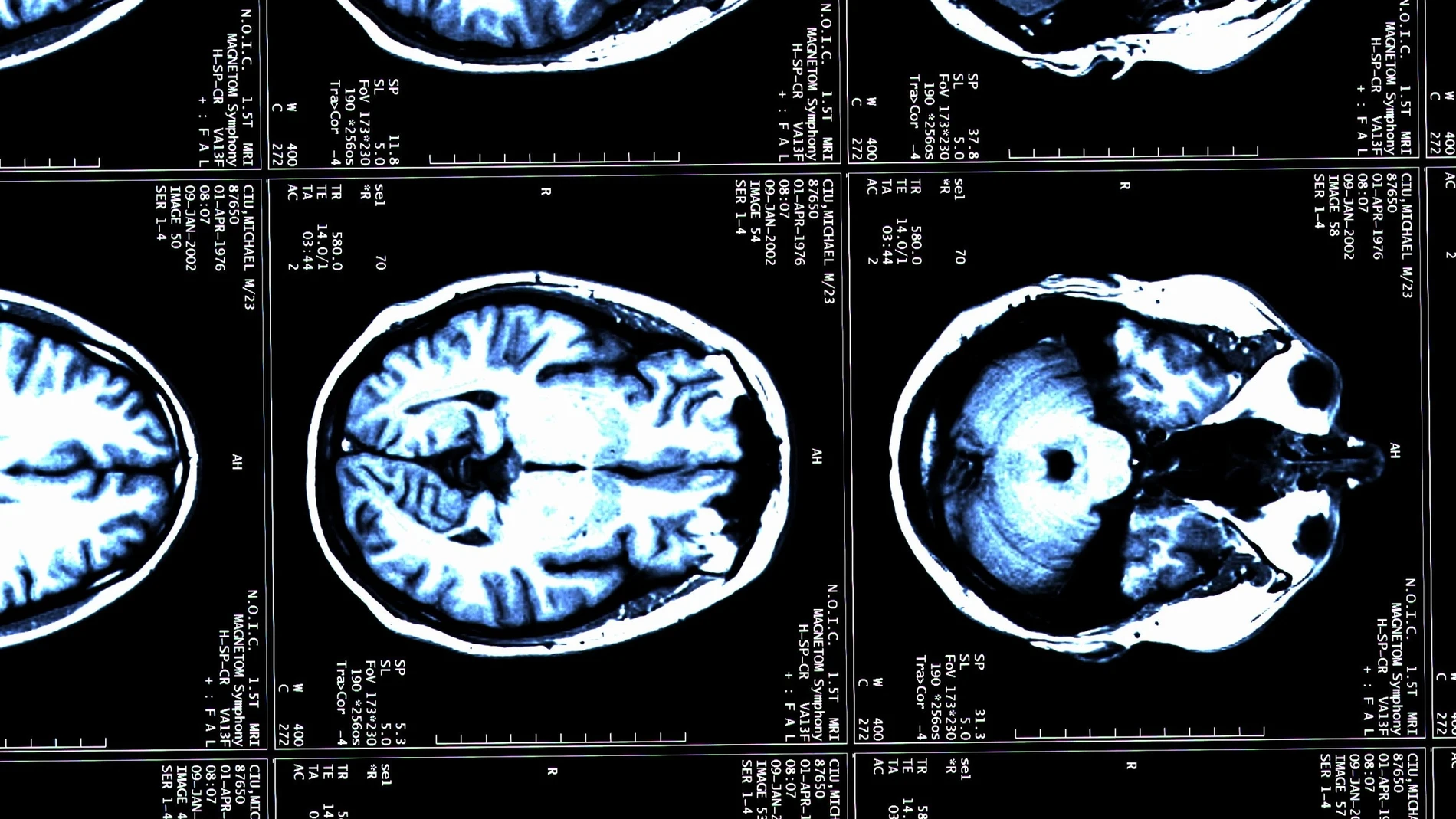 Una resonancia magnética cerebral de una paciente con esclerosis múltiple