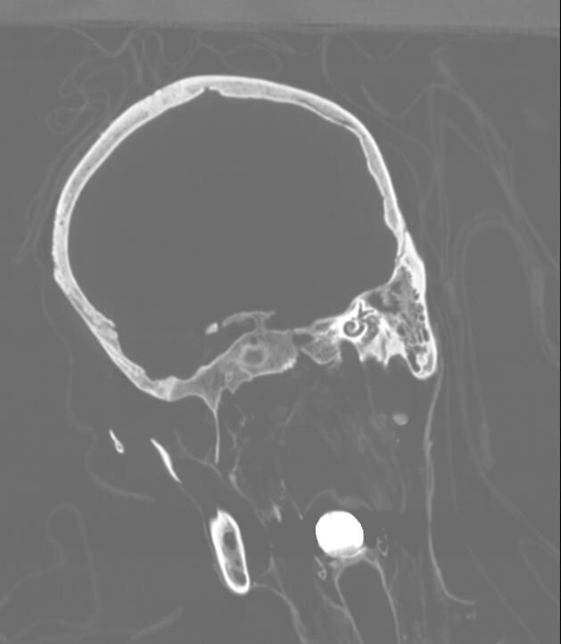 La imagen radiológica permite apreciar un objeto metálico en la laringe del santo