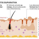 Hidradenitis supurativa