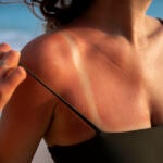 Una mujer muestra las marcas que le han quedado por el sol