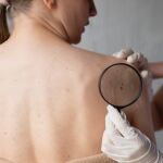 Inteligencia Artificial aplicada a la detección de lesiones en la piel