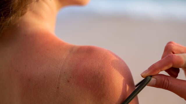 Tomar mucho tiempo el sol sin protección puede provocar cáncer de piel