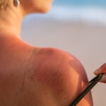 Tomar mucho tiempo el sol sin protección puede provocar cáncer de piel