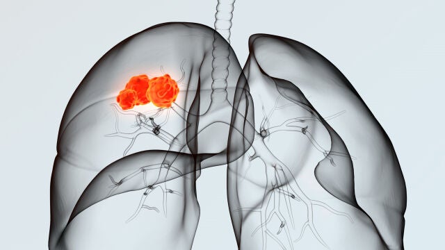 Cáncer de pulmón