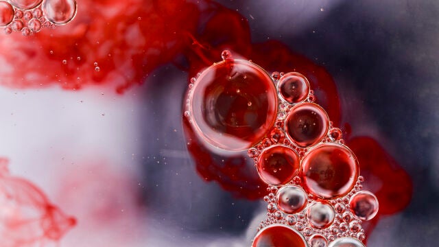 El mieloma múltiple es la segunda neoplasia hematológica más frecuente
