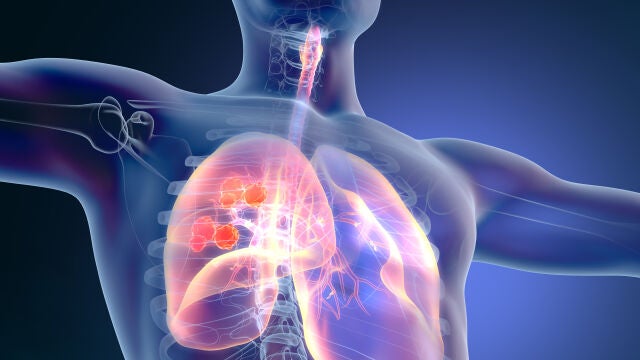 El cáncer de pulmón