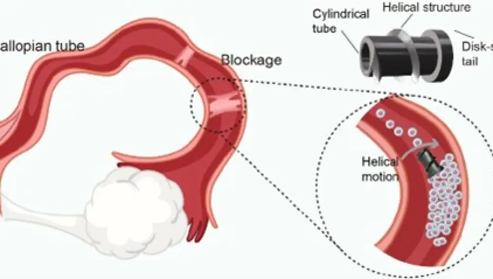Microrrobot magnético en forma de tornillo para la recanalización de oviductos. El microrrobot magnético elimina la obstrucción mediante movimiento mecánico bajo un campo magnético giratorio.