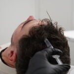 Los exosomas ofrecen muchas aplicaciones en la dermatología estética, aquí la jeringa los deposita en el cuero cabelludo para su aplicación de forma tópica en un tratamiento de alopecia