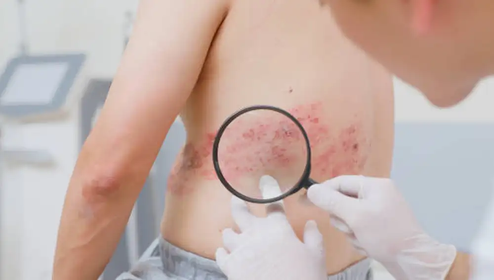 Demnet Shingles Así puedes identificar el Herpes Zóster: estos son sus principales síntomas