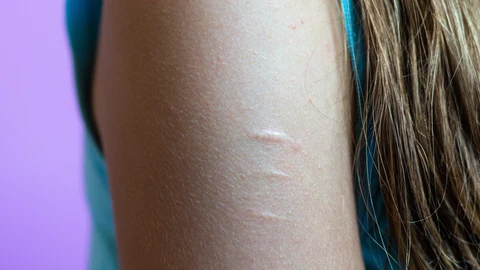 Autolesiones en el brazo de una joven