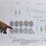 MADRID.-Investigadores del Clínico San Carlos revelan nuevos cambios cerebrales y alteraciones cognitivas en Covid persistente