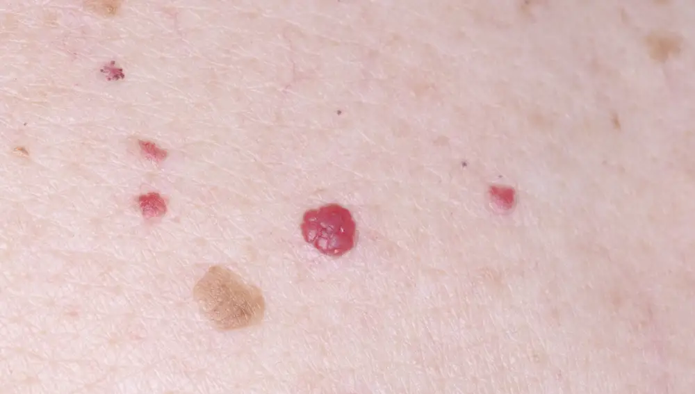 Angiomas