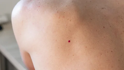 Lunares rojos en la piel: qué son y qué dicen sobre tu salud