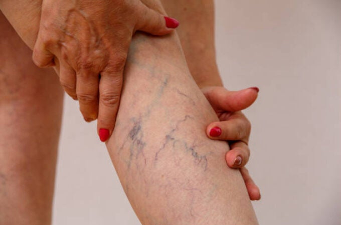 Varices 