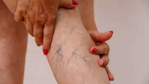 Varices