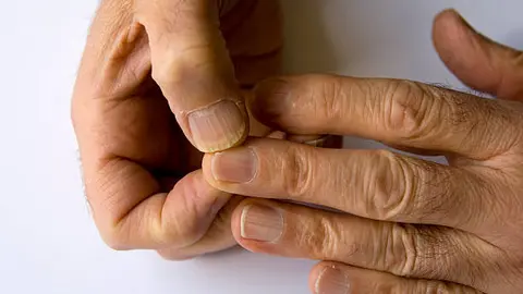 Las marcas en las uñas que pueden ofrecer indicios sobre la salud y el bienestar de una persona